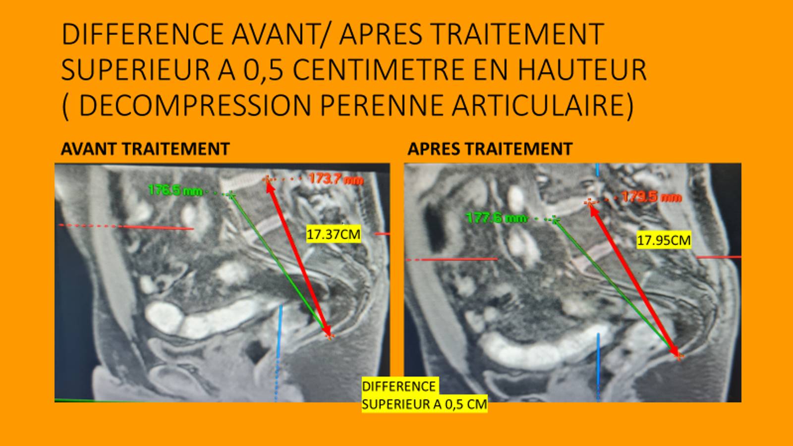 L&#8217;Enthésothérapie, qu&#8217;est-ce que c&#8217;est ? Erstein 3