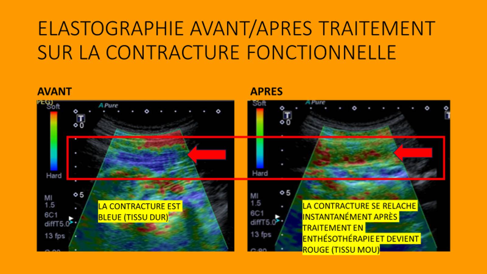 L&#8217;Enthésothérapie, qu&#8217;est-ce que c&#8217;est ? Bischwiller 2